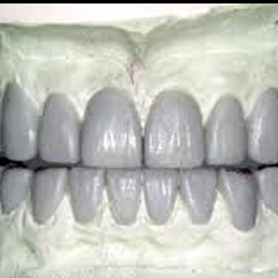 Diagnostic Wax Ups